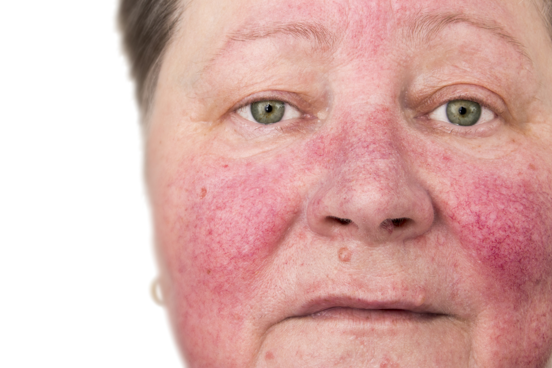 do rosacea and dry skin come from your gut smaller.jpeg